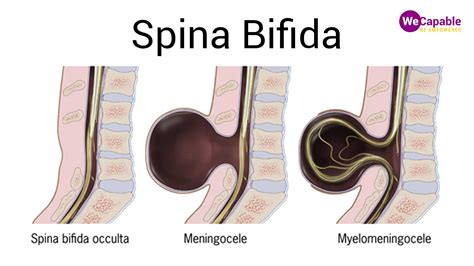 Spina Bifida 